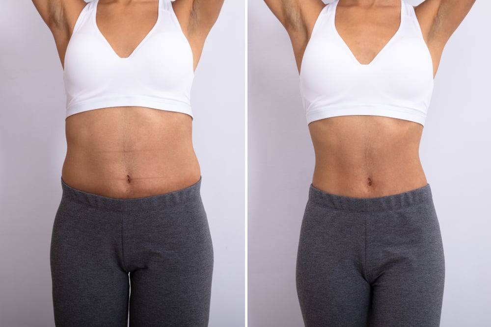 Before,And,After,Concept,Showing,Fat,To,Slim,Woman